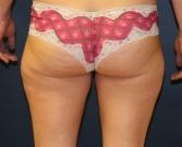 Feel Beautiful - Liposuction Thinner Thighs - Before Photo