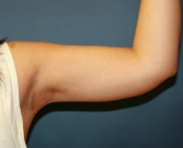 Feel Beautiful - Liposuction Arms (left) - After Photo