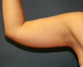 Feel Beautiful - Liposuction Right Arm - Before Photo