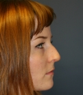 Feel Beautiful - Remove Bump on Nose San Diego - Before Photo