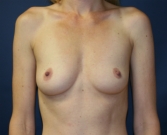 Feel Beautiful - Natural Breast Augmentation San Diego 1 - Before Photo