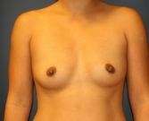 Feel Beautiful - Natural Breast Augmentation San Diego 2 - Before Photo