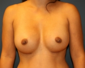 Feel Beautiful - Natural Breast Augmentation San Diego 2 - After Photo