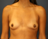 Feel Beautiful - Natural Breast Augmentation San Diego 3 - Before Photo