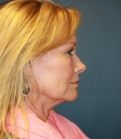 Feel Beautiful - Neck and Lower Face Lift San Diego - Before Photo