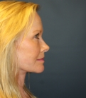 Feel Beautiful - Neck and Lower Face Lift San Diego - After Photo