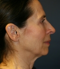 Feel Beautiful - Neck and Lower Face Rejuvenation - Before Photo