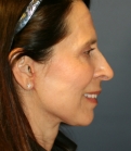 Feel Beautiful - Neck and Lower Face Rejuvenation - After Photo