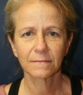 Feel Beautiful - NeckLift Neck Lift San Diego - Before Photo