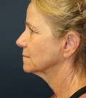 Feel Beautiful - NeckLift Neck Lift San Diego - Before Photo