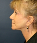 Feel Beautiful - NeckLift Neck Lift San Diego - After Photo