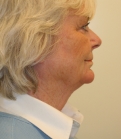 Feel Beautiful - Neck and Lower Face Re-shaping - Before Photo