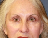 Feel Beautiful - Removing grafted eyelid fat - Before Photo