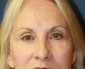Feel Beautiful - Removing grafted eyelid fat - After Photo