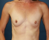 Feel Beautiful - Breast Implants after five years - Before Photo