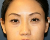 Feel Beautiful - Lower eyelid bulges removal - Before Photo