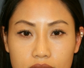 Feel Beautiful - Lower eyelid bulges removal - After Photo
