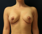 Feel Beautiful - Breast Reduction San Diego 23 - After Photo