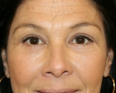 Feel Beautiful - Lower eyelid tightening surgery - After Photo