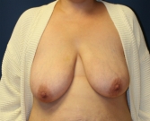 Feel Beautiful - Breast Lift San Diego 29 - Before Photo