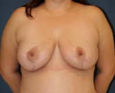 Feel Beautiful - Breast Lift San Diego 29 - After Photo