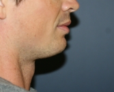 Feel Beautiful - Chin Implant for Men - Before Photo