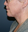Feel Beautiful - Necklift and Corner of Lip Lift - After Photo