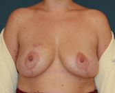 Feel Beautiful - Breast Reduction San Diego 24 - After Photo