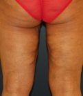 Feel Beautiful - upper thigh-lift-san-diego - After Photo