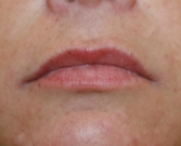 Feel Beautiful - Filler (Glucuronic Acid) in Upper and Lower Lips - Before Photo