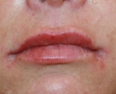 Feel Beautiful - Filler (Glucuronic Acid) in Upper and Lower Lips - After Photo