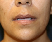 Feel Beautiful - Lip Lift Before and After - Before Photo