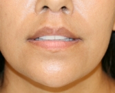 Feel Beautiful - Lip Lift Before and After - After Photo