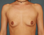Feel Beautiful - Before and One Month After Breast Enlargement - Before Photo