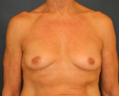 Feel Beautiful - Breast Implants - Before Photo
