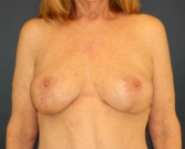 Feel Beautiful - Breast Implant Removal with Breast Lift - After Photo