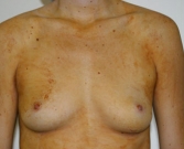 Feel Beautiful - Breast Augmentation Case 7 - Before Photo