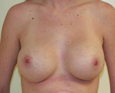 Feel Beautiful - Breast Augmentation Case 7 - After Photo