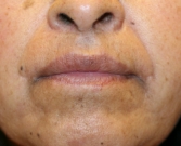 Feel Beautiful - Restylane Into Creases Around Lips - Before Photo