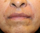 Feel Beautiful - Restylane Into Creases Around Lips - After Photo