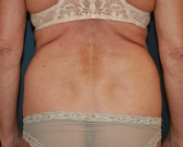 Feel Beautiful - Liposuction Waist, Mini-Tummy Tuck - Before Photo