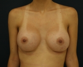 Feel Beautiful - Breast Augmentation Natural 4 - After Photo