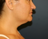 Feel Beautiful - Necklift by liposuction - Before Photo