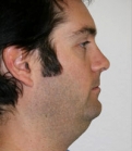 Feel Beautiful - Necklift Case 1 - Before Photo