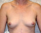 Feel Beautiful - Breast Augmentation Case 9 - Before Photo