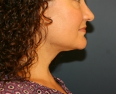 Feel Beautiful - Necklift by liposuction - After Photo