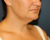 Feel Beautiful - Neck-Lift by Liposuction - Before Photo