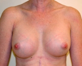 Feel Beautiful - Breast Augmentation Case 9 - After Photo