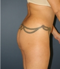 Feel Beautiful - Lipo Flanks & Thighs, Fat to Buttocks - Before Photo