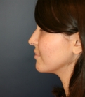 Feel Beautiful - Implant at Base of Nose - Before Photo